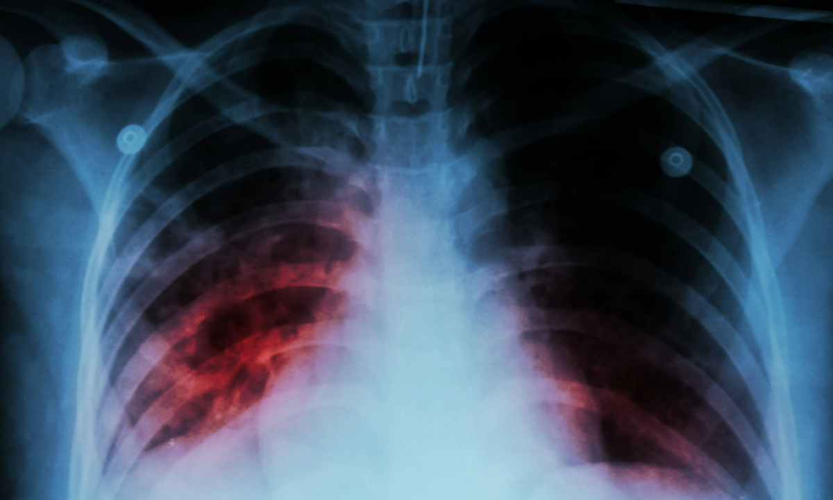 Kansas Faces Major Tuberculosis Outbreak 2 Dead and 146 Infected